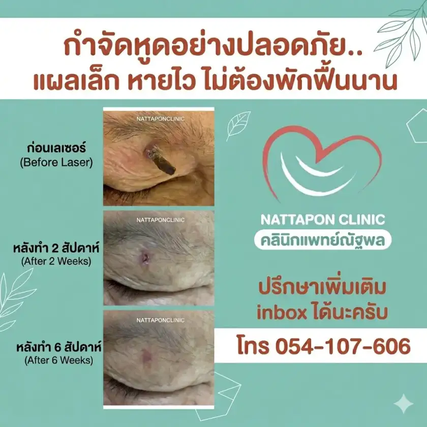 คลินิกแพทย์ณัฐพลลำปาง เลเซอร์ไฝ ขี้แมลงวัน สิวอุดตัน สิวหิน หูด ตาปลา ติ่งเนื้อ กระเนื้อ ต่อมไขมัน