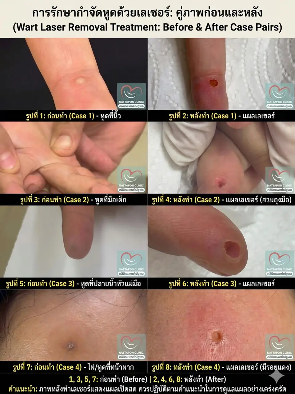 คลินิกแพทย์ณัฐพลลำปาง การรักษากำจัดหูดด้วยเลเซอร์ เลเซอร์ไฝ ขี้แมลงวัน สิวอุดตัน สิวหิน หูด ตาปลา ติ่งเนื้อ กระเนื้อ ต่อมไขมัน